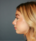 Feel Beautiful - Rhinoplasty 221 - After Photo